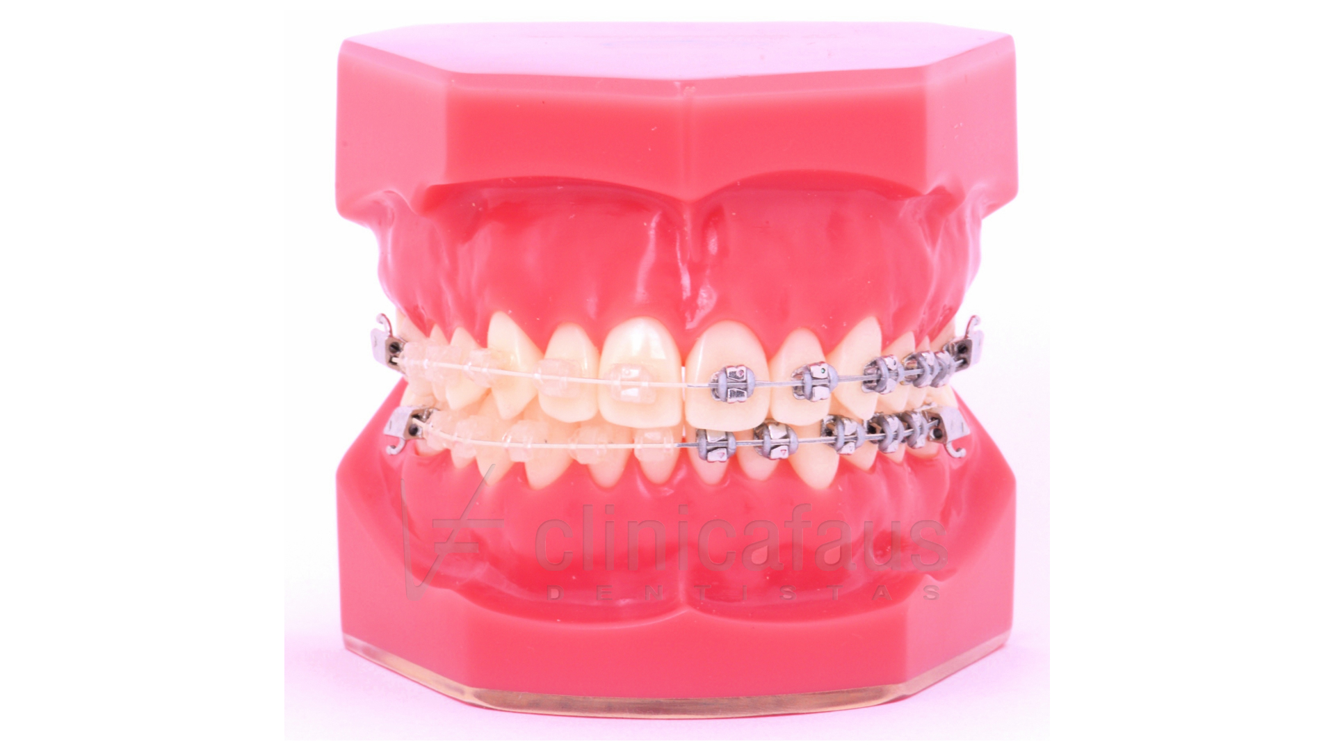 brackets transparentes