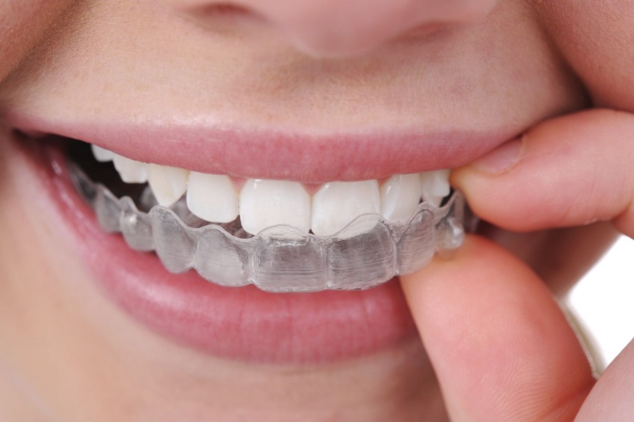 Ortodoncia invisible invisalign valencia