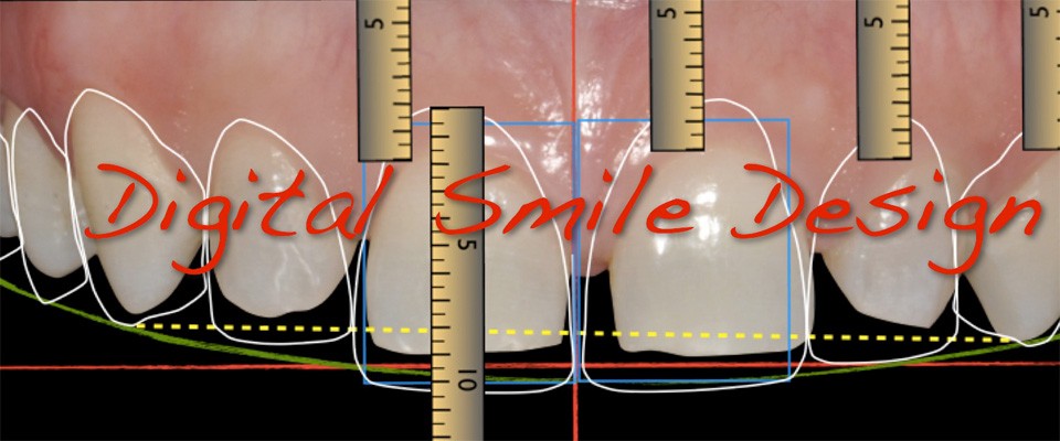 digital smile design