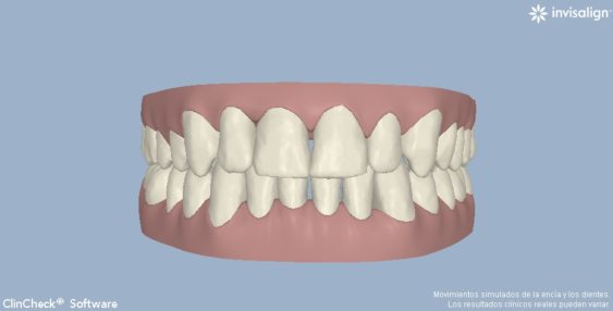 clincheck invisalign ortodoncia invisible valencia