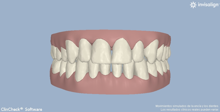 ortodoncia invisible invisalign valencia