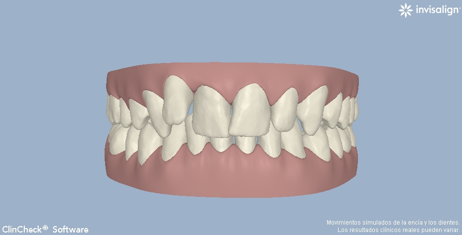 ortodoncia invisible invisalign valencia