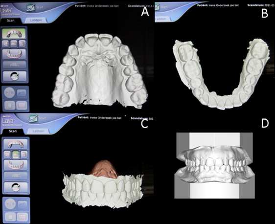 escáner intraoral