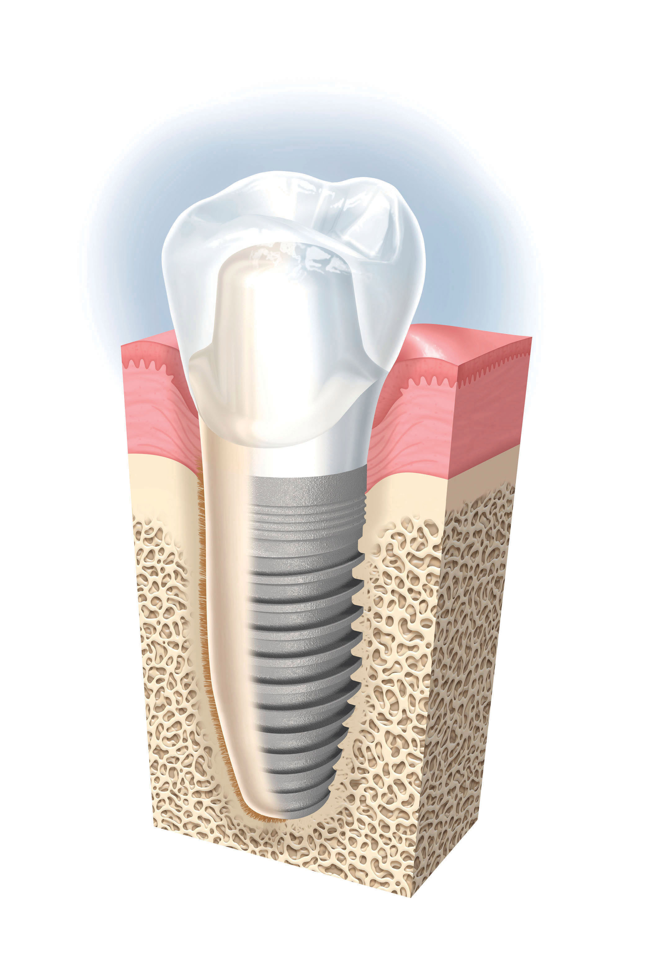 precio de los implantes dentales