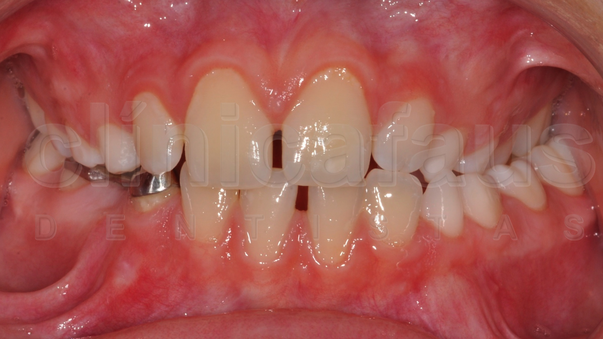 maloclusion