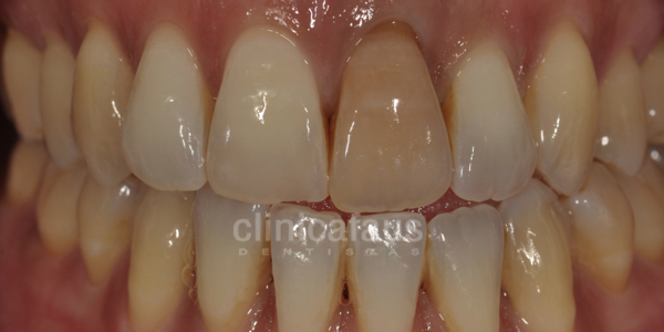 blanqueamiento dental estetica, ortodoncia e implantes.006