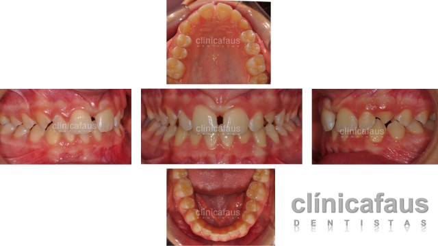 espacio entre los dientes diastema.001