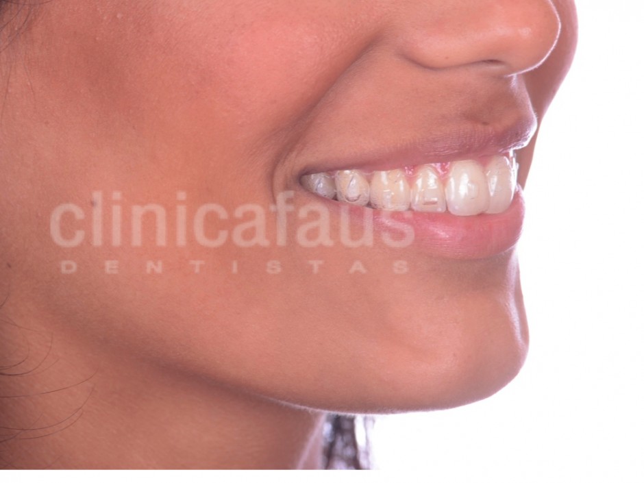 tipos de ortodoncia invisalign ortodoncia invisible valencia