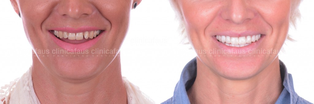 carillas de porcelana en valencia composite ceramica dentista estetica dental