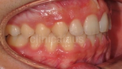 ortodoncia valencia algemesi