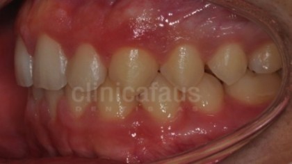 ortodoncia valencia algemesi