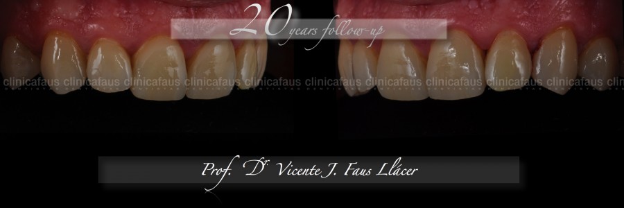 carillas dentales ceramica composite valencia