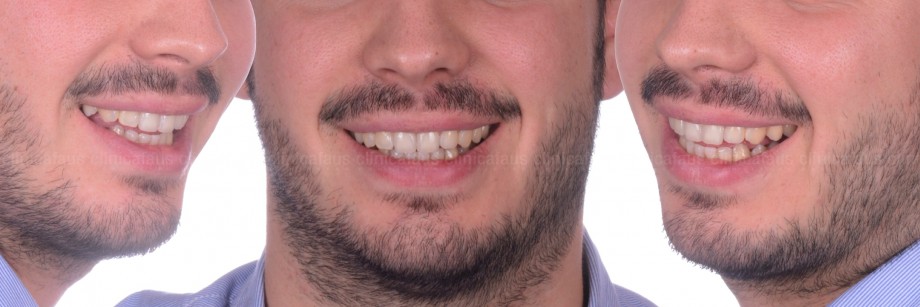 carillas valencia ortodoncia estetica dental