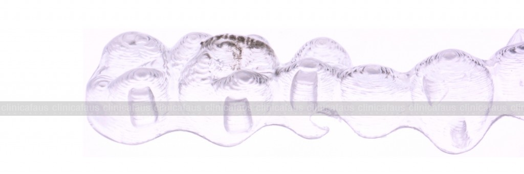 ortodoncia invisible invisalign