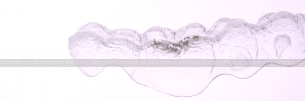 ortodoncia invisible invisalign corte de precisión