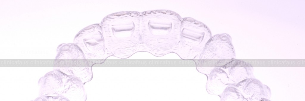 ortodoncia invisible valencia invisalign.009