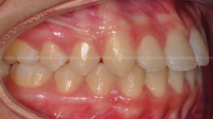 clase III ortodoncia valencia algemesi
