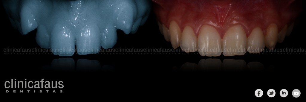 ortodoncia antes y después algemesi valencia