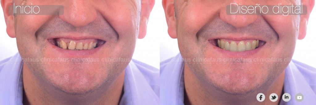 carillas sin tallado valencia dentista algemesi clinica dental alzira sueca carcaixent valencia