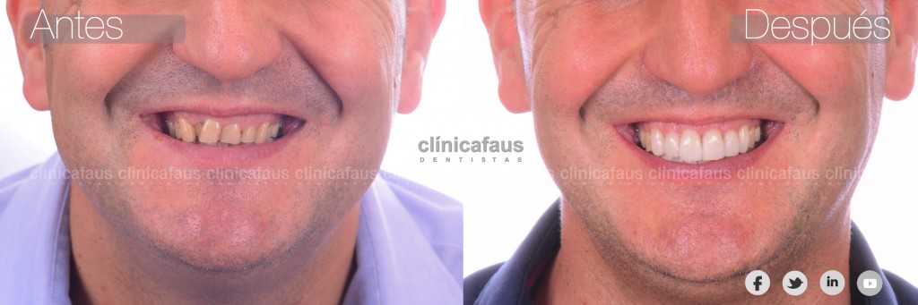 carillas dentales de porcelana dentista algemesi clinica dental alzira sueca carcaixent valencia