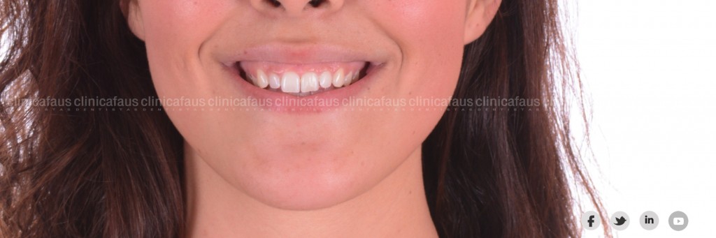 Ortodoncia, carillas, blanqueamiento dental valencia algemesi dentista clinica dental.003
