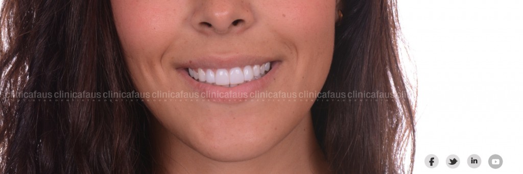 Ortodoncia, carillas, blanqueamiento dental valencia algemesi dentista clinica dental.003