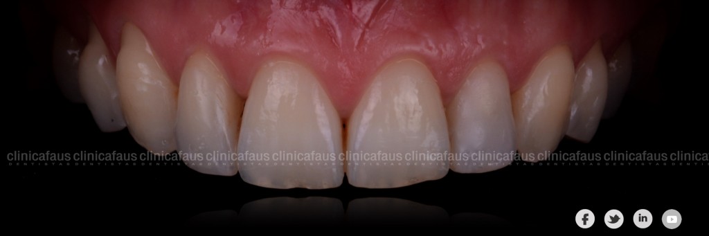 invisalign y carillas dentales valencia algemesi cullera sueca cullera