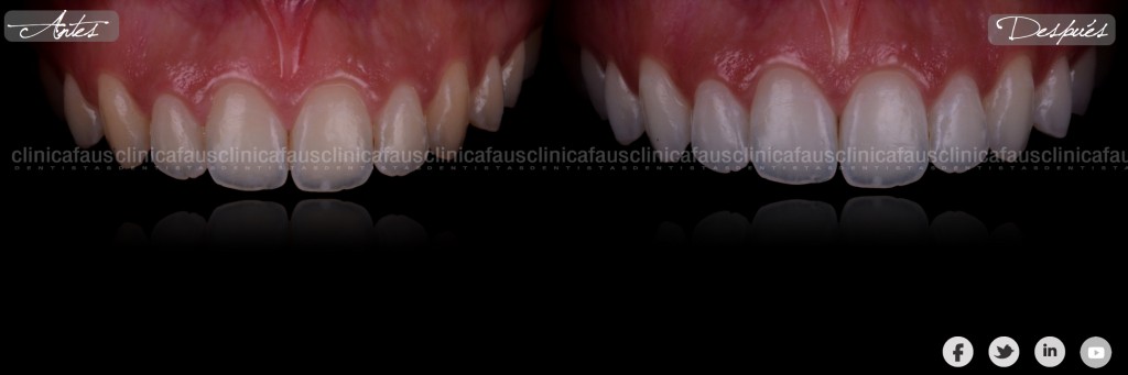 blanqueamiento dental valencia algemesi clinica dental dentista ortodoncia alzira carcaixent sueca cullera.002