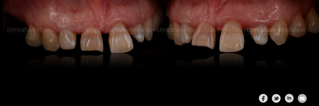 sonrisa gingival carillas dentales ortodoncia valencia algemesi alzira sueca cullera xativa carcaixent dentista clinica dental.004
