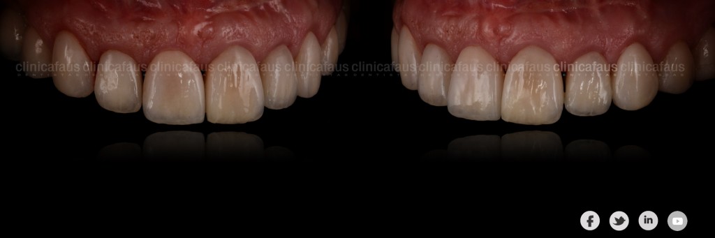 sonrisa gingival carillas dentales ortodoncia valencia algemesi alzira sueca cullera xativa carcaixent dentista clinica dental.007