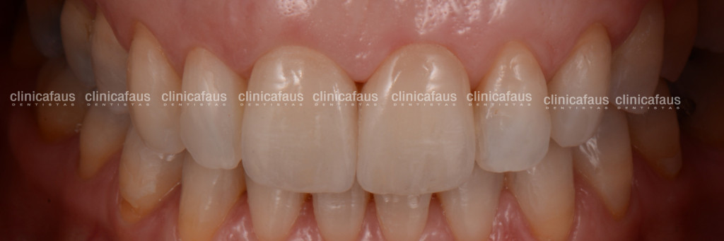 ortodoncia invisible carillas dentales blanqueamiento algemesi valencia sueca carcaixent alzira cullera españa.001