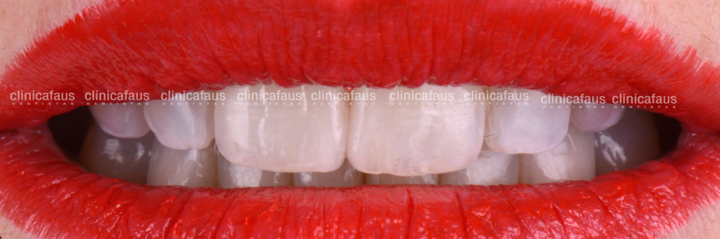 ortodoncia invisible carillas dentales blanqueamiento algemesi valencia sueca carcaixent alzira cullera españa.001