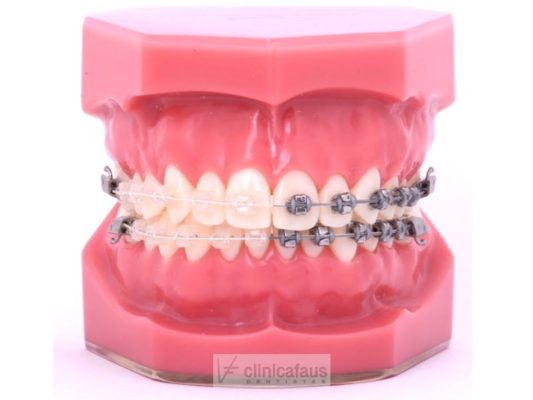 ortodoncia estetica en clinica faus