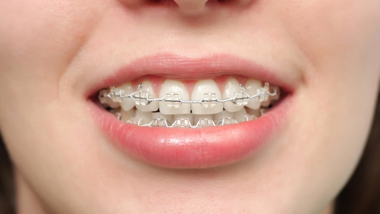 Conoces los diferentes tipos de brackets? - Clínica Faus