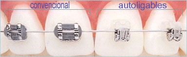 Brackets autoligables