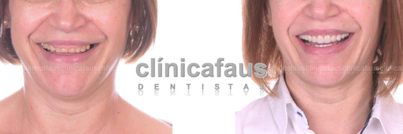 carillas dentales porcelana o composite valencia algemesi sueca estetica dental