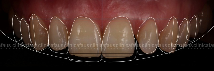 digital smile design dentista algemesi clinica dental alzira sueca carcaixent valencia