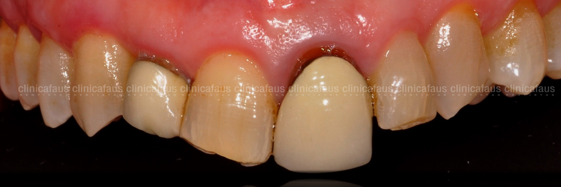 ortodoncia, ccarillas sin tallado y fundas sin metal caso complejo clase III mordida cruzada anterior sin extracciones sin cirugia carillas de ceramica dentista algemesi valencia sueca carcaixent alzira .001