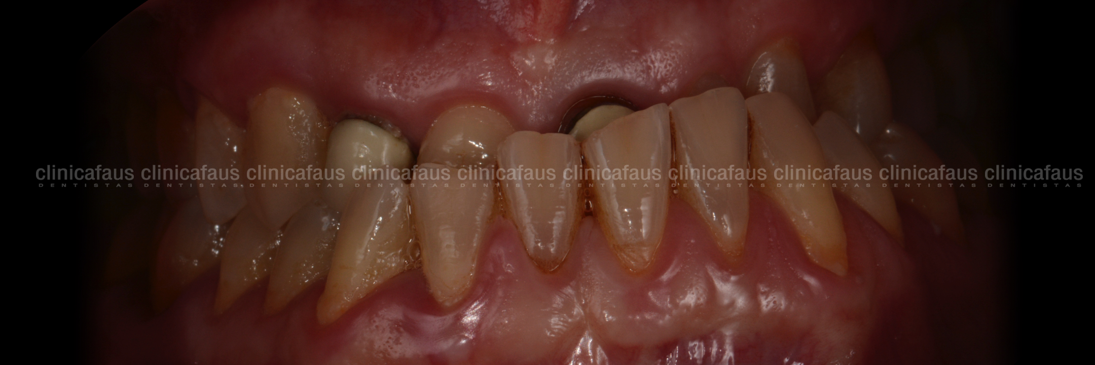 ortodoncia, carillas sin tallado y fundas sin metal caso complejo clase III mordida cruzada anterior sin extracciones sin cirugia carillas de ceramica dentista algemesi valencia sueca carcaixent alzira .001