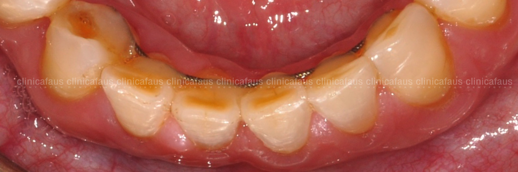 ortodoncia, carillas sin tallado y fundas sin metal caso complejo clase III mordida cruzada anterior sin extracciones sin cirugia carillas de ceramica dentista algemesi valencia sueca carcaixent alzira .001