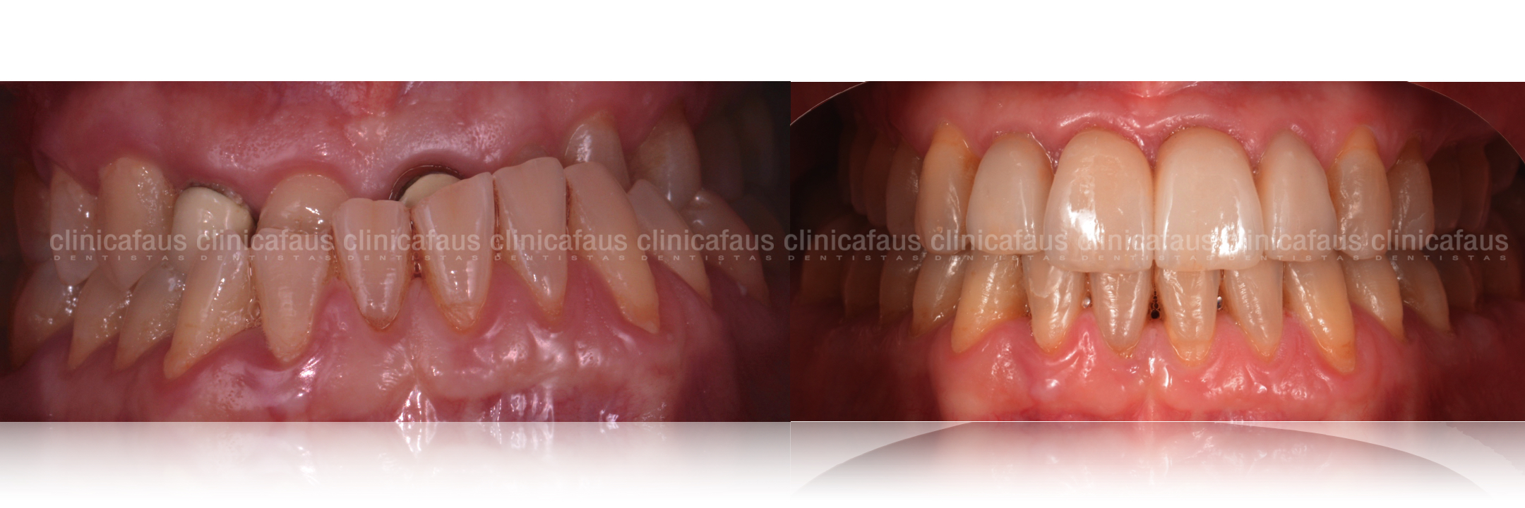 caso complejo clase III mordida cruzada anterior sin extracciones sin cirugia carillas de ceramica dentista algemesi valencia sueca carcaixent alzira .001