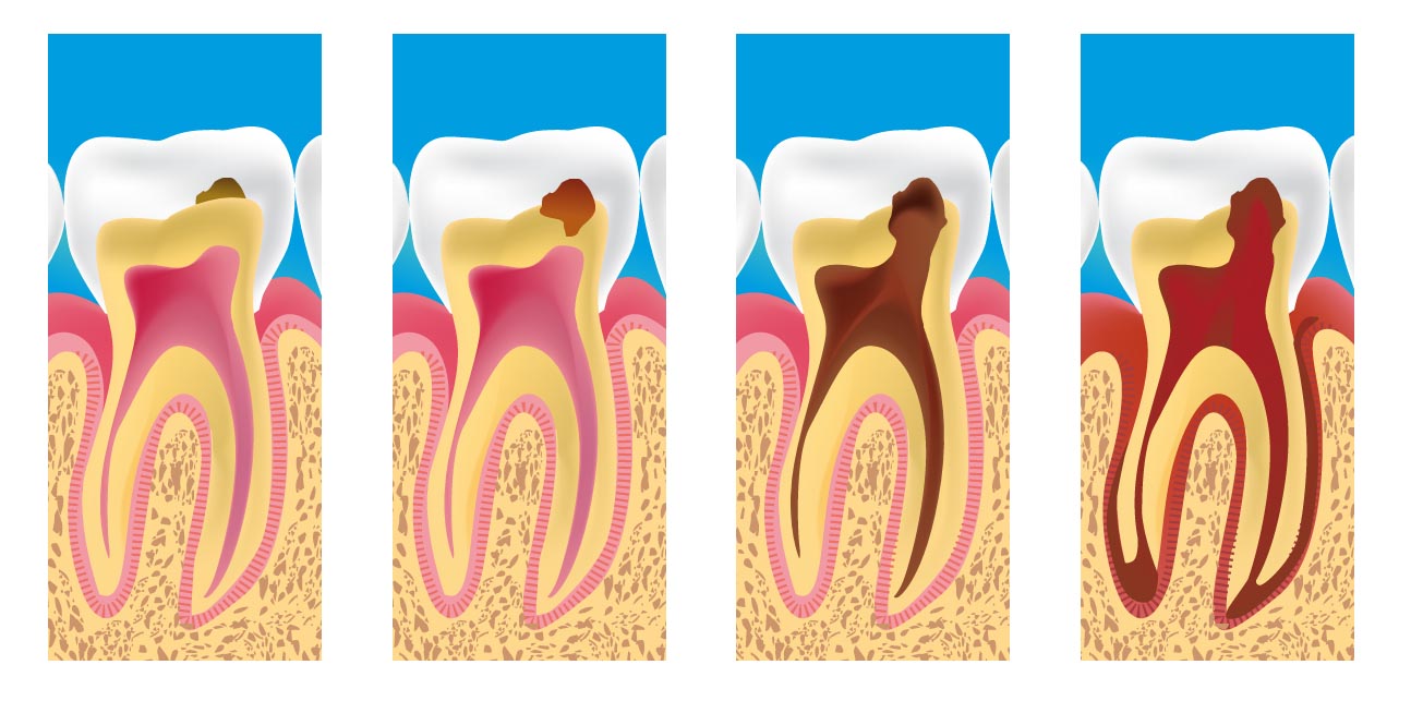 endodoncia algemesi valencia