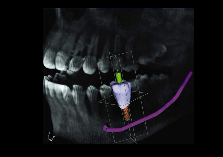 implantes dentales en alzira