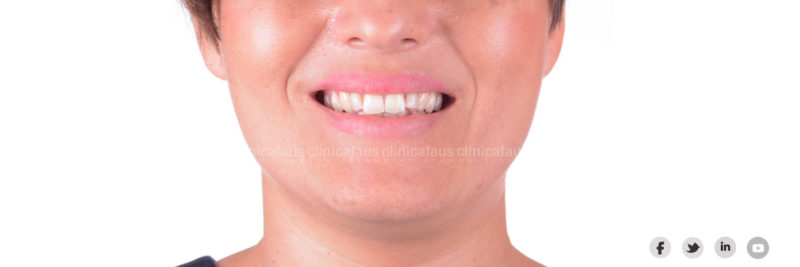 invisalign y carillas para mejorar la sonrisa en clinica dental algemesi valencia alzira sueca cullera
