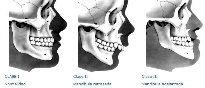 maloclusion