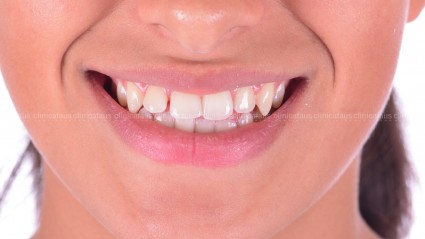 clase III con espacios entre los dientes