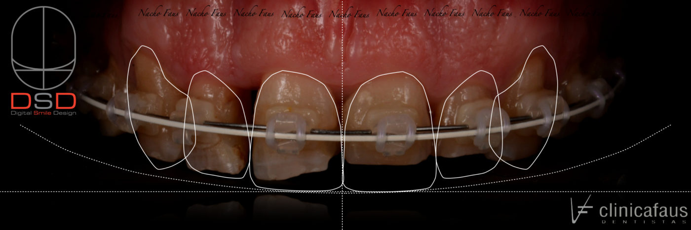 diseño digital de sonrisa