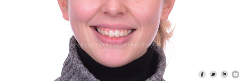 ortodoncia invisible valencia