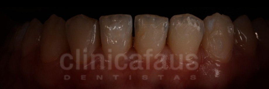 stripping dental ortodoncia valencia