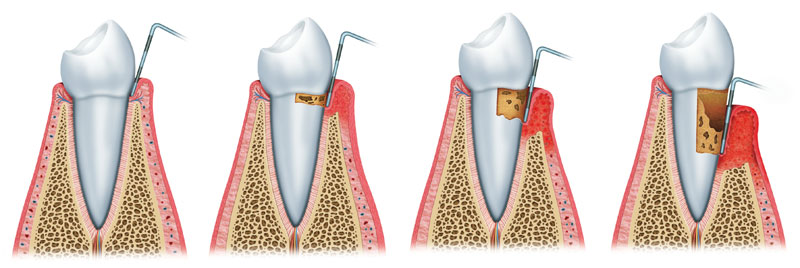 Periodoncia en clinica Faus algemesi